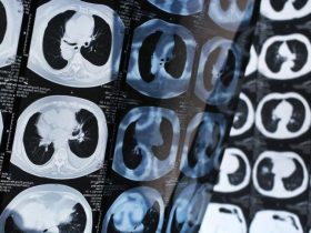 科学家研发开创性肺癌疫苗,研究显示可预防高达90%病例